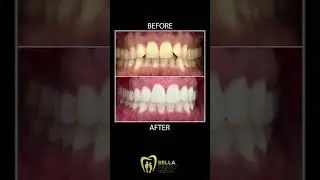 Bella Family Dental - Invisalign Limited-Time Offer #shorts