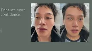 Non-Surgical Rhinoplasty/Nose Job with Dermal Filler #nosejobbeforeandafter #nosejobs #dermalfillers