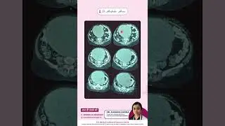 Understanding Uterine Tumor| Best Cancer Doctor In Agra #trendingshorts #ytshorts #shortsfeed