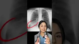 Рентген грудной клетки 🩻