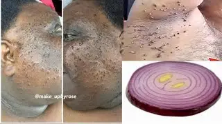 USE ONION REMOVE SKIN TAG INSTANTLY FASTEST RESULT EVER