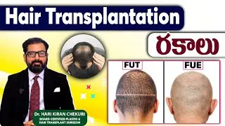 FUT Vs FUE: Types of Hair Transplantation Methods In Telugu || Dr Harikiran Chekuri || ReDefine