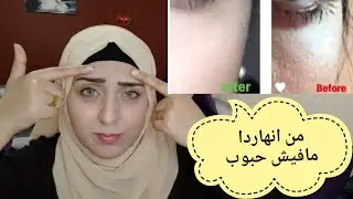 علاج نهائي للحبوب اللي تحت الجلد/واسباب ظهورها