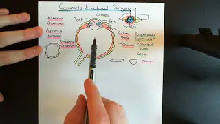 Cataracts and Cataract Surgery Part 1