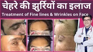 चेहरे की झूरियाँ कैसे हटाए | झूरियों का इलाज | Treatment of Fine lines & wrinkles in hindi