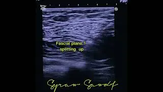 Modified PEC block for thoracic/ Breast post surgical pain: A demo by Dr Sairah Sadaf