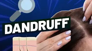 Dandruff and Hair Loss &ndash; How to Treat Dandruff & Regrow Your Hair