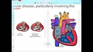 Pathology : Rheumatic heart disease part 1