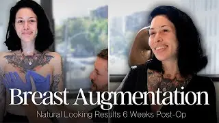 Plastic Surgery Journey: From Surgery to 6 Weeks Post-Op
