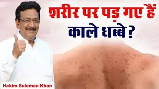 शरीर पर पड़ गए हैं काले धब्बे? Hakim Suleman Khan | Ishwar TV