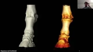 P3 Fracture with Lesions
