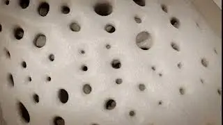 Osteoporosis