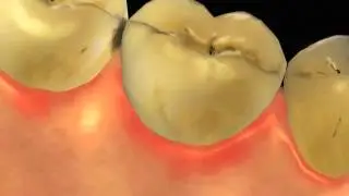 Full Dental Restoration