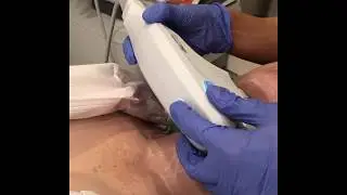 Dr. Alexander Ovchinsky - Ultherapy