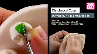 Lower Right 1st Molar distobuccal cusp 3 ridge (young-aged) Wax-Up #46-1