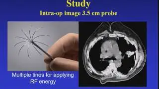 Ablative Therapies as first line treatment