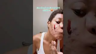 The ordinary for acne Journey