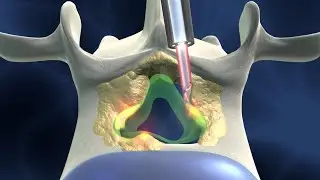 Laser Spine Surgery Springfield TN (615) 988 - 4831 | Sciatica, Back Pain, Spinal Stenosis