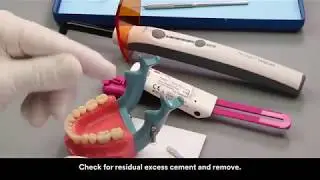 RelyX Lute 2 clicker cementation on a  PFM crown