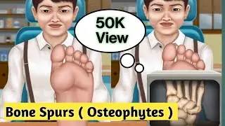 Bone Growth & Treatment |Bone Spurs | Osteophytes| @elearn2bsmart | Bone spurs Diagnosis & Treatment