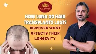 How Long Do Hair Transplants Last? Discover What Affects Their Longevity | Crown Hair Transplant