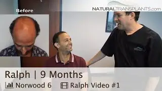 Hair Transplant Results After 9 Months 