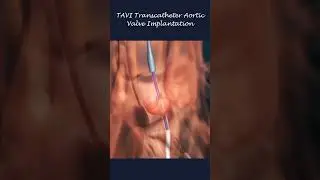 TAVI Transcatheter Aortic Valve Implantation