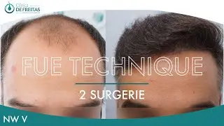 Hair Graft Technique FUE - 6124 Grafts (15628 Hairs) - Dr. Rafael de Freitas