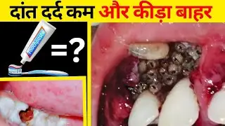 दांत दर्द ? दांत सडन? दांत में कीडे ? का ईलाज| Tooth Pain #toothpain #teethcare