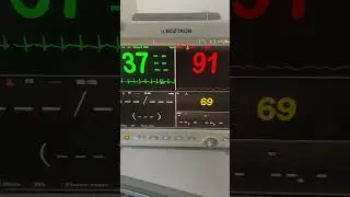 Monitor icu anak dengan kecurigaan sepsis #shorts #intensivecareunit #hospital #rumahsakit #doctor