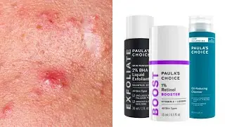 Top 7 Paula's Choice Skincare for Acne