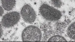 Over 200 cases of monkeypox now reported in Georgia