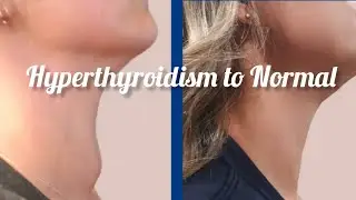CURE MY THYROID PROBLEM WITH IN 2 MONTH// 5 LIFESTYLE CHANGES THAT CURE MY THYROID