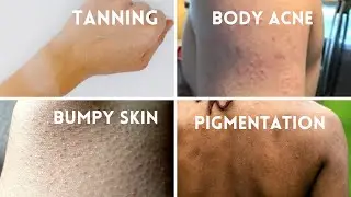 Do these 2 THINGS ONLY for - Tanning, Body Acne, Bumpy Skin, Pigmentation| WishCare Body Lotions