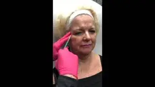 Botox Injections Crows Feet - Newport News - Williamsburg VA