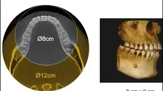 3D imaging vs 2d imaging. Why CBCT is better than IOPA or X ray ?