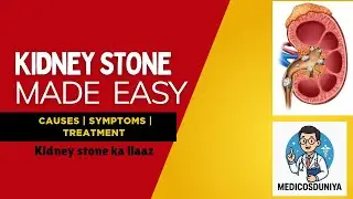 Kidney stone made easy | kidney stone ka ilaaz | kidney stone treatment 