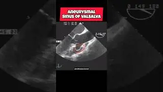Sinus Of Valsalva Aneurysm on Echo