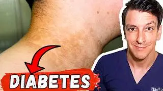 Hidden Signs You May Have Diabetes (Most People Miss them)