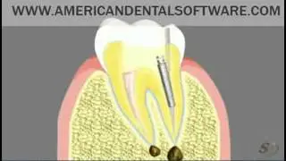 Dental Patient Education Root Canal Treatment Animated Movie
