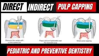 Direct & Indirect Pulp Capping | Apexogensis | Indication & Contraindications | Diagnosis