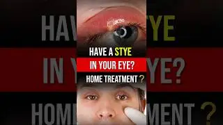 How to Treat a Stye at Home? 👁️ Easy Remedies for Eye Bump!