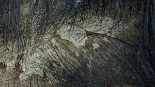 ASMR Satisfying Scalp Cleanse & Removal #0004