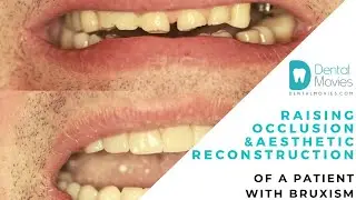 Raising occlusion & aesthetic reconstruction of a patient with bruxism