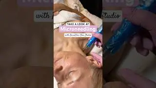 Why We Treat the Neck & Chest with Microneedling 👏