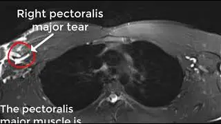 Pectoralis major rupture