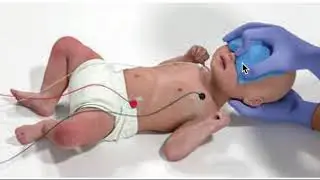SVT in Children: Vagal, Drugs, & Cardioversion
