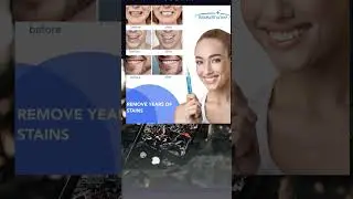 Best Selling Teeth Whitening Pen on Amazon - Teeth Stain Remover to Whiten Teeth