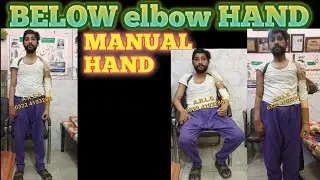 Below elbow hand prosthetic local systam  in LAHORE PAKISTAN #prosthetics #artificialhand #limb