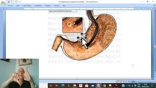 Gastric disorders in Arabic 11 ( Bleeding chronic peptic ulcer ) , by Dr. Wahdan